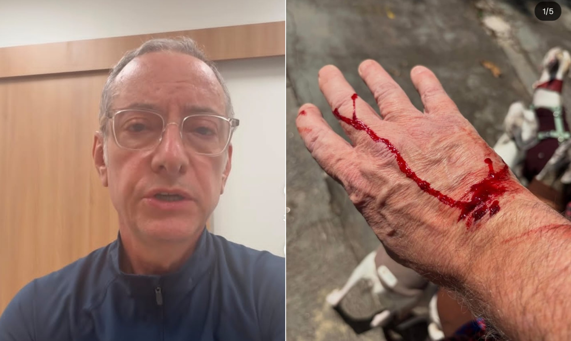 José Roberto Burnier, âncora do SP2, sofre ataque de pitbull solto em São Paulo