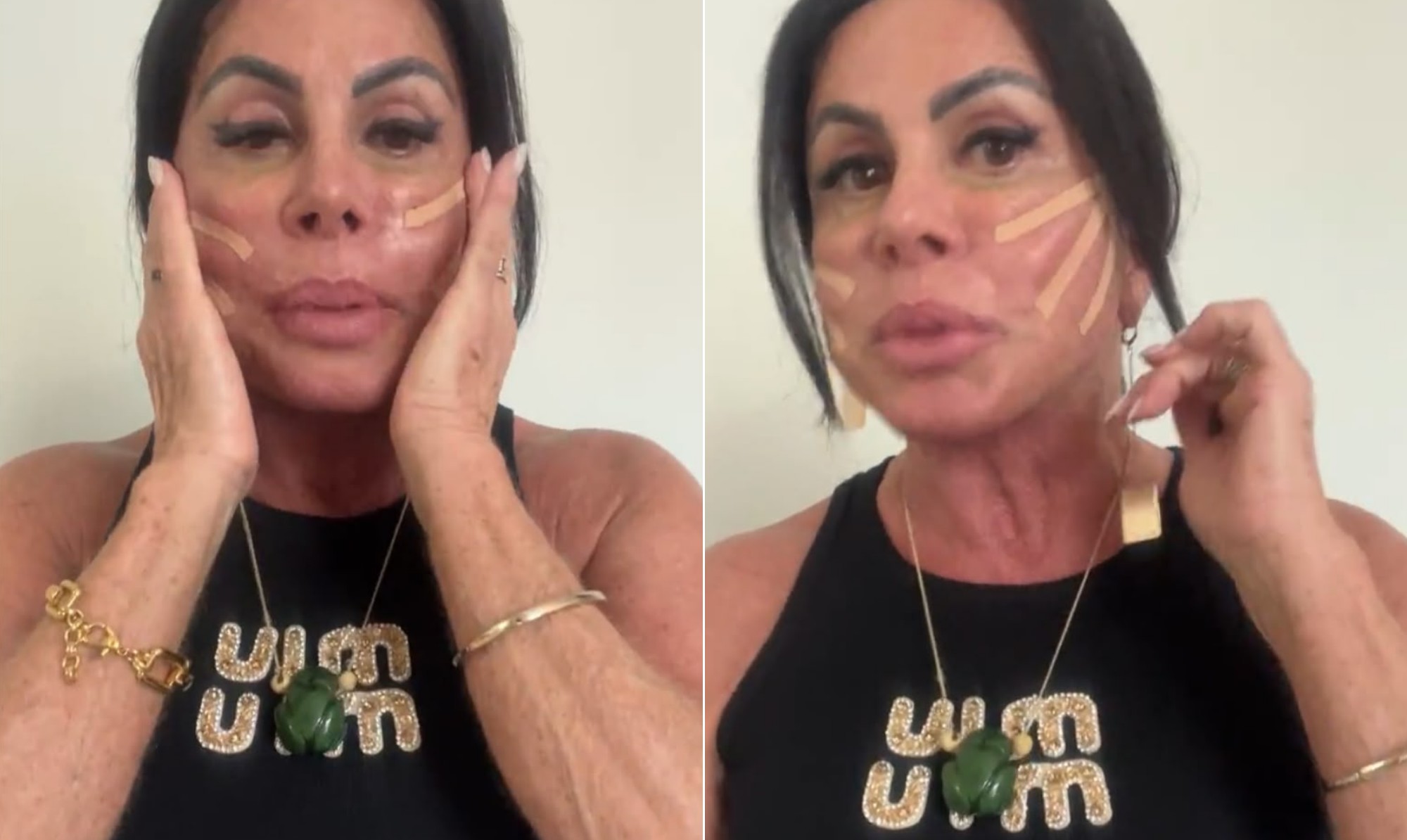 Gretchen exibe novos procedimentos estéticos nas redes sociais