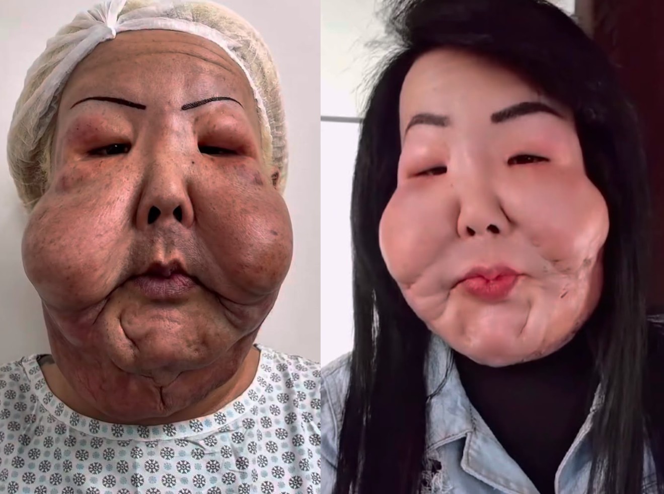 Médico revela transformação facial de Juju do Pix após cirurgias para remoção de óleo mineral