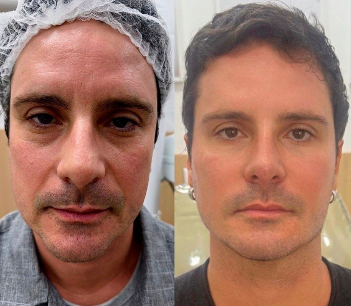 Sérgio Abreu, ex-galã de Malhação, faz harmonização facial aos 51 anos