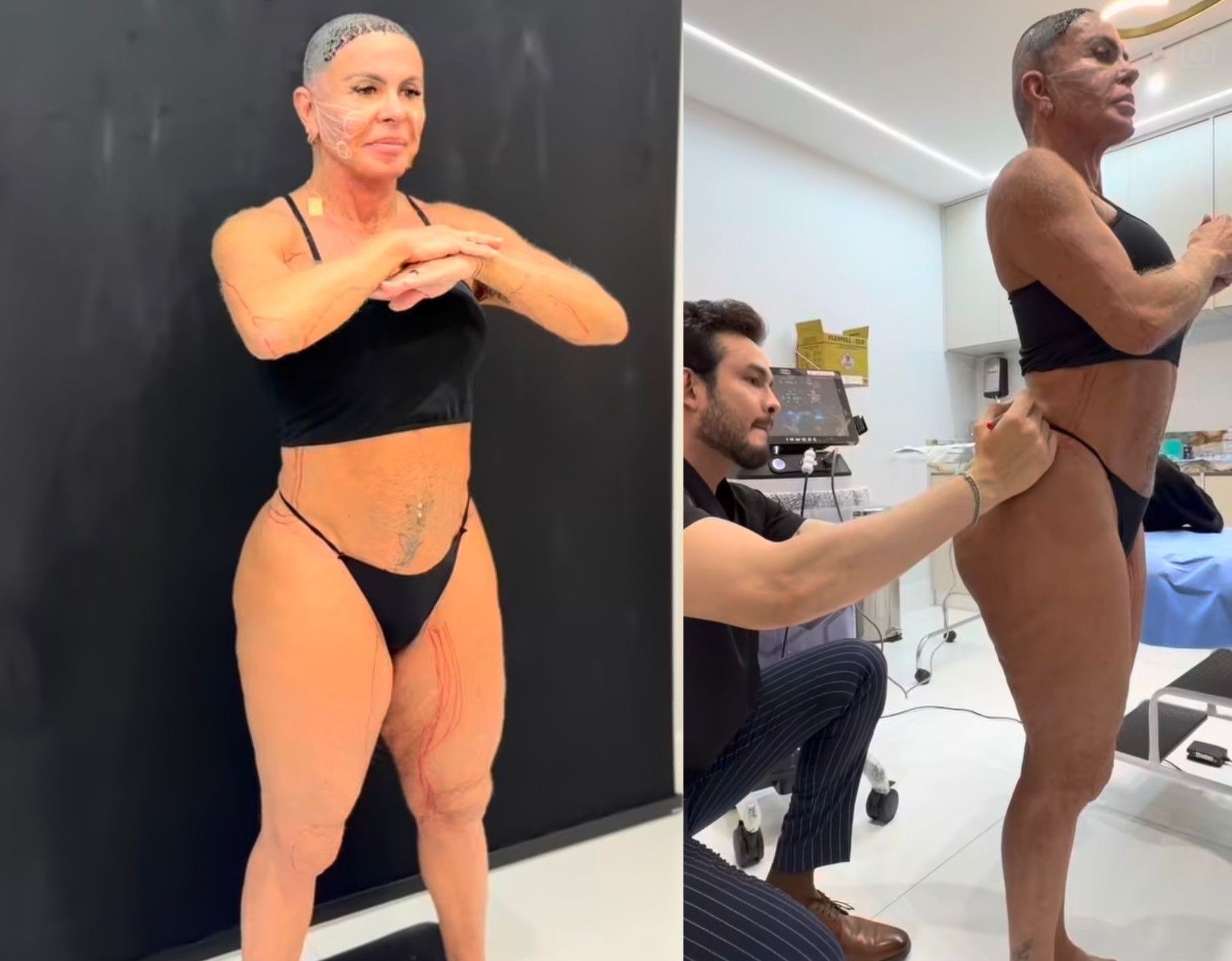 Gretchen exibe resultado de novo tratamento contra flacidez no corpo e no rosto