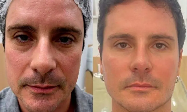 Sérgio Abreu, ex-galã de Malhação, faz harmonização facial aos 51 anos