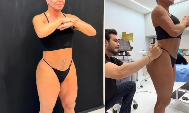 Gretchen exibe resultado de novo tratamento contra flacidez no corpo e no rosto