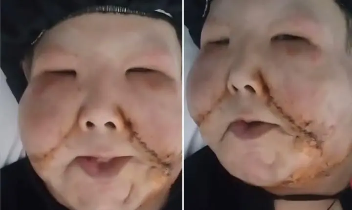 Juju do Pix celebra 2ª cirurgia que retirou óleo mineral do rosto: 'Ficou do jeito que eu queria'